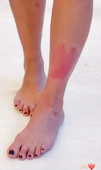 Псориаз на ноге Ким Кардашьян